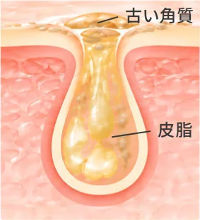毛穴の状態2：皮脂・古い角質が残る